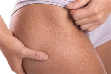 How To Prevent Stretch Marks From Getting Worse During Pregnancy