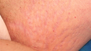 Developing Stretch Marks