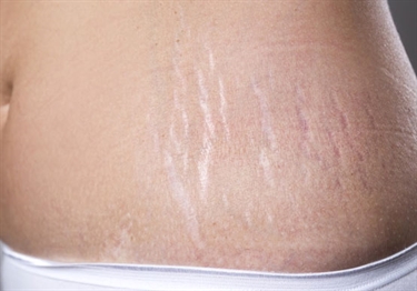 What Do Stretch Marks Look Like When They First Start
