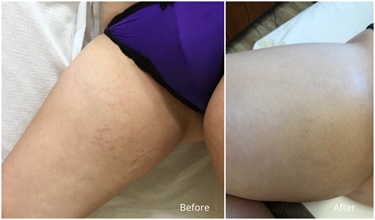 How To Prevent Stretch Marks During Pregnancy Cocoa Butter