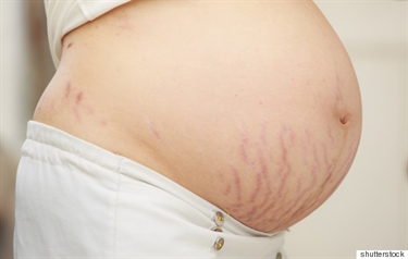 How To Get Rid Of Baby Fat After C Section