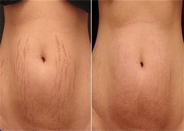 How We Get Stretch Marks During Pregnancy