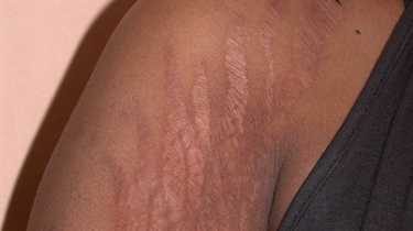 What Can I Use To Prevent Pregnancy Stretch Marks