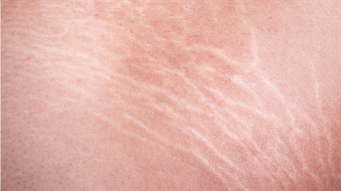 How To Reduce The Apperance Of Stretch Marks