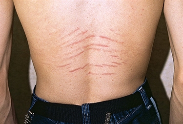 Best Way To Prevent Stretch Marks While Pregnant