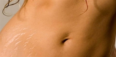 Pregnancy Stretch Marks Pics