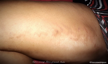 How To Eliminate Stretch Marks