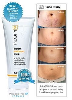 Quickest Way To Remove Stretch Marks