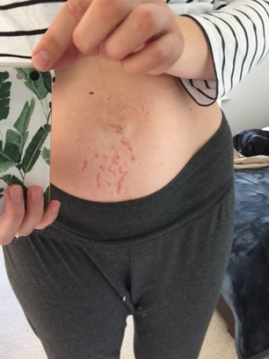 What Are Stretch Marks