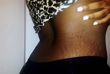 What Does A Pregnancy Rash Look Like