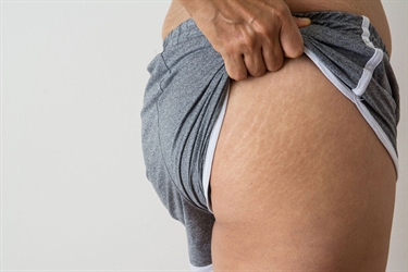 How Do Celebrities Avoid Stretch Marks During Pregnancy