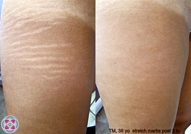White Stretch Marks Before And After