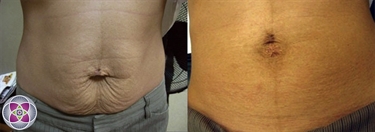Boob Stretch Mark