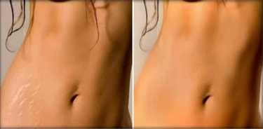 Oil To Prevent Stretch Marks