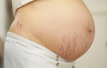 How Do U Get Stretch Marks