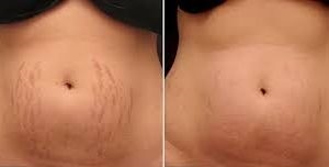 What Do New Stretch Marks Look Like
