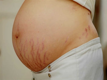 Stretch Mark Itch Relief