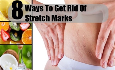 What Can I Use To Get Rid Of Stretch Marks
