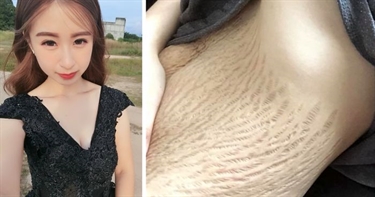 The Cause Of Stretch Marks