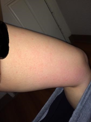 How To Remove Dark Spots On Legs Fast Naturally