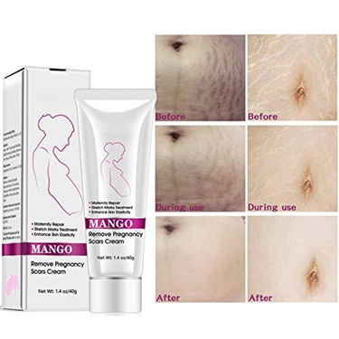 How To Get Stretch Marks To Go Away