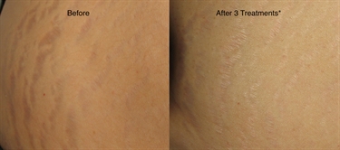 Back Stretch Marks From Growing