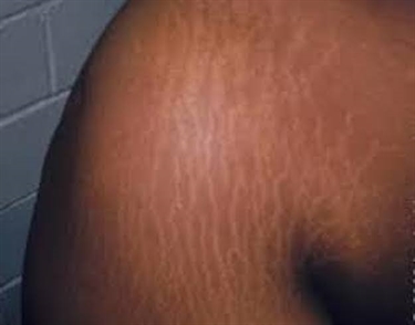 Brown Stretch Marks
