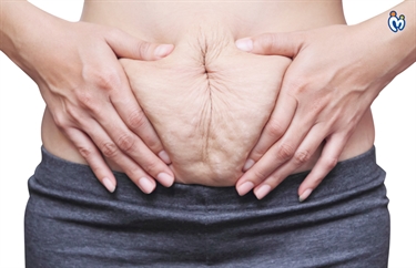 Free Stretch Mark Cream