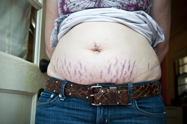 Why Do Some Get Stretch Marks After Pregnancy