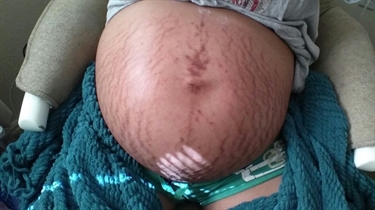 Remove Stretch Marks On Breasts
