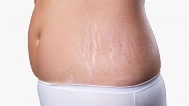 Reddish Purple Marks On Skin