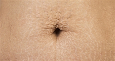 How To Get Rid Of Pregnancy Line On Stomach