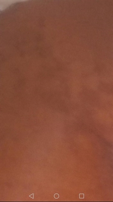 Purple Spots On Buttocks