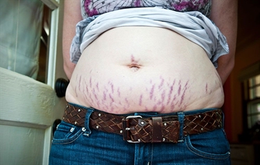 Extreme Stretch Marks After Pregnancy