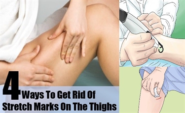 How To Get Stretch Marks