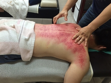 How To Get Rid Of Stretch Marks On Your Sides
