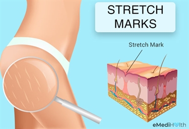 What Is The Best Thing To Use For Stretch Marks