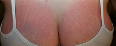 Can You Get Rid Of Stretch Marks Permanently