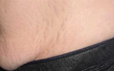 Pregnancy Belt Stretch Marks What To Expect