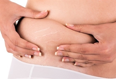 Stretch Marks During Pregnancy Medical Name