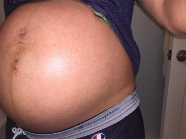 Witch Hazel Pads During Pregnancy