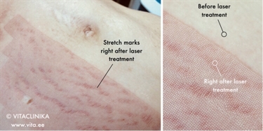 What To Use To Prevent Pregnancy Stretch Marks