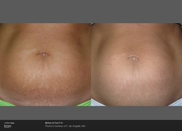 Pregnancy Stretch Marks Cream During Pregnancy