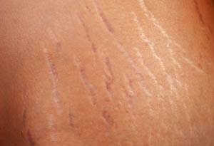 Does Aloe Help With Stretch Marks
