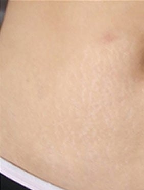 Tips To Get Rid Of Stretch Marks
