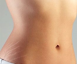 Cocoa Butter To Prevent Stretch Marks
