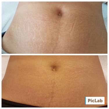 Good Lotion For Stretch Marks During Pregnancy