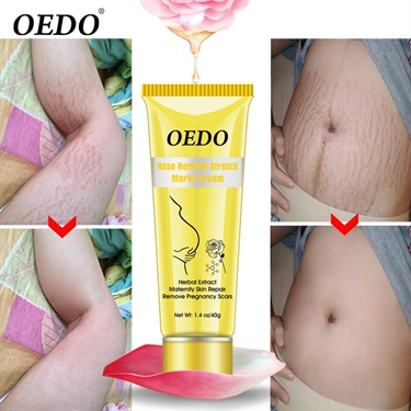 Fading Stretch Marks