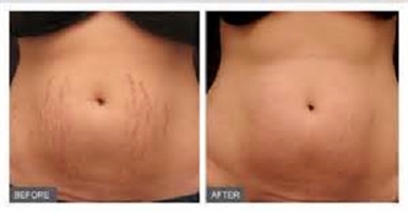 Stomach After Pregnancy