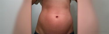 To Prevent Stretch Marks
